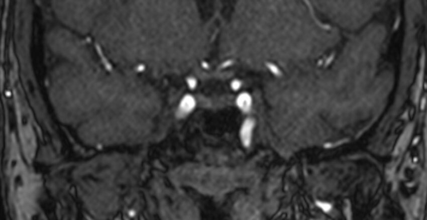 Basilar artery fenestration (Radiopaedia 74537-85455 Coronal MRA TOF 7).jpg