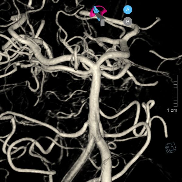 File:Basilar artery perforator aneurysm (Radiopaedia 82455-97734 3D view left VA 48).jpg