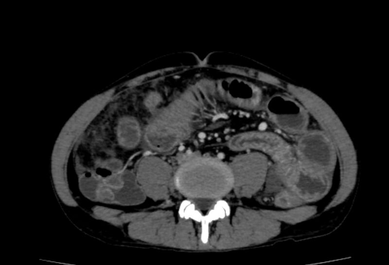 File:Behçet's disease- abdominal vasculitis (Radiopaedia 55955-62570 A 51).jpg