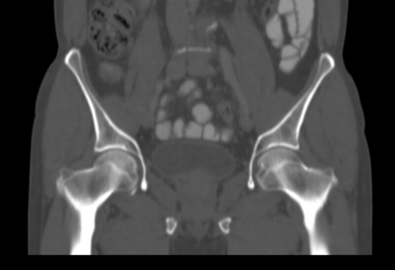 File:Bertolotti syndrome (Radiopaedia 58974-66235 Coronal bone window 25).jpg