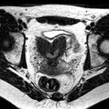 Bicornuate uterus (Radiopaedia 11104-11492 Axial T2 19).jpg