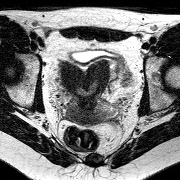 File:Bicornuate uterus (Radiopaedia 11104-11492 Axial T2 19).jpg