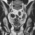 Bicornuate uterus (Radiopaedia 11104-11492 Coronal T2 15).jpg