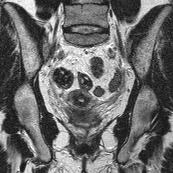 File:Bicornuate uterus (Radiopaedia 11104-11492 Coronal T2 15).jpg