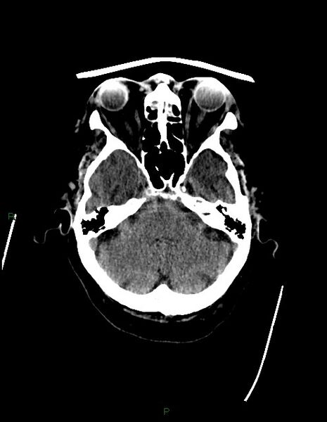 File:Bilateral acute middle cerebral artery territory infarcts (Radiopaedia 77319-89401 Axial non-contrast 21).jpg