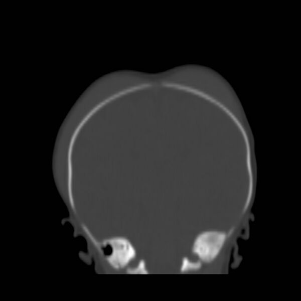File:Bilateral cephalohematomas and subdural hematomas (Radiopaedia 26778-26929 Coronal bone window 17).jpg