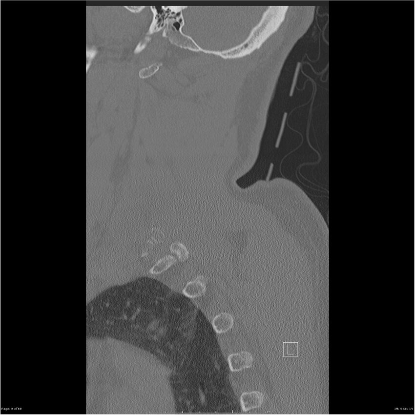 Bilateral cervical ribs (Radiopaedia 25868-26017 Sagittal bone window 8).jpg