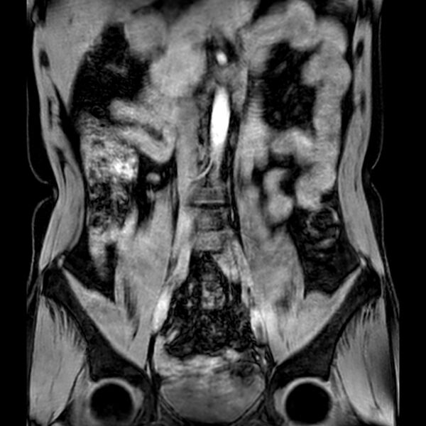File:Bilateral conjoined nerve roots at different levels (Radiopaedia 73312-84063 Coronal WE 6).jpg