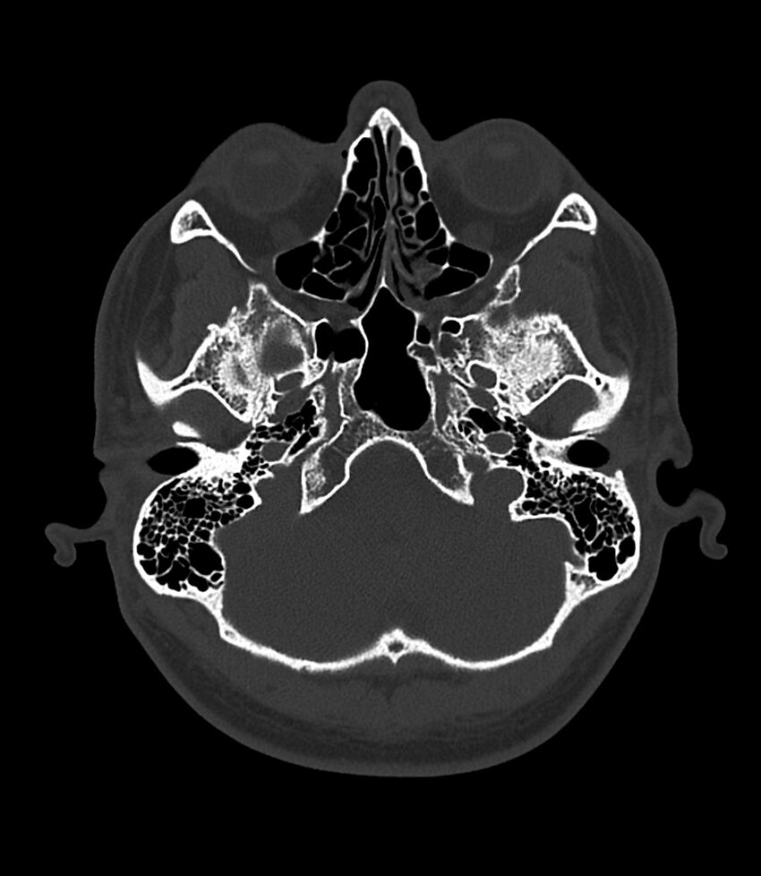 Bilateral medial canal fibrosis (Radiopaedia 85598-101344 Axial bone window 13).jpg