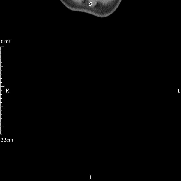 File:Bilateral medullary nephrocalcinosis with ureteric calculi (Radiopaedia 71269-81569 Coronal non-contrast 85).jpg