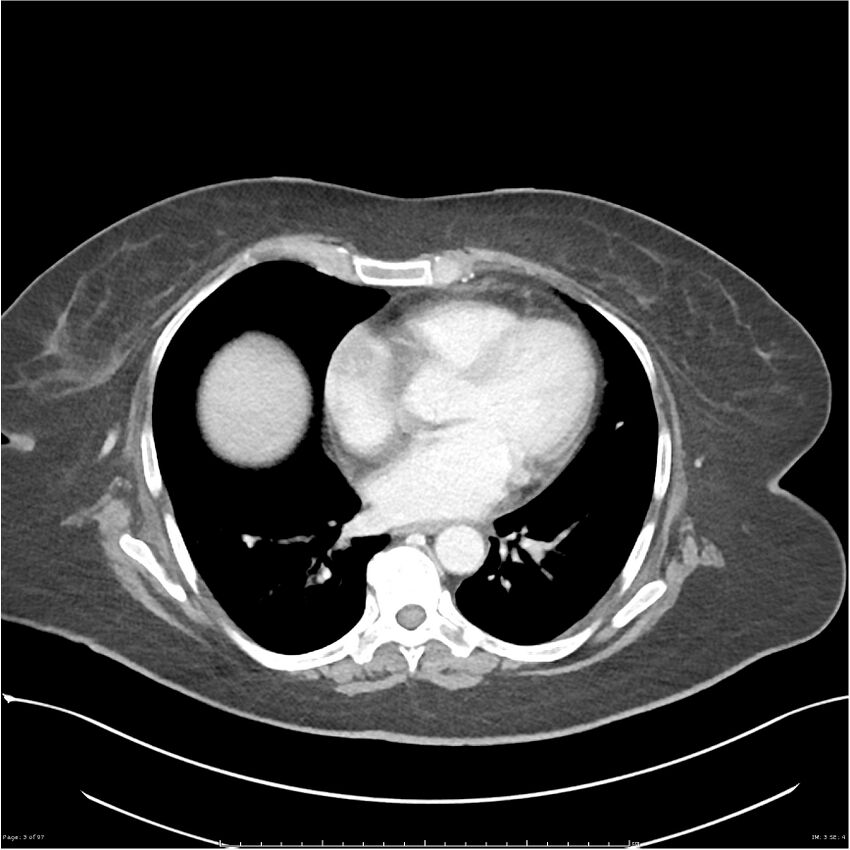 Bilateral psoas hematomas (Radiopaedia 24057-24279 A 3).jpg
