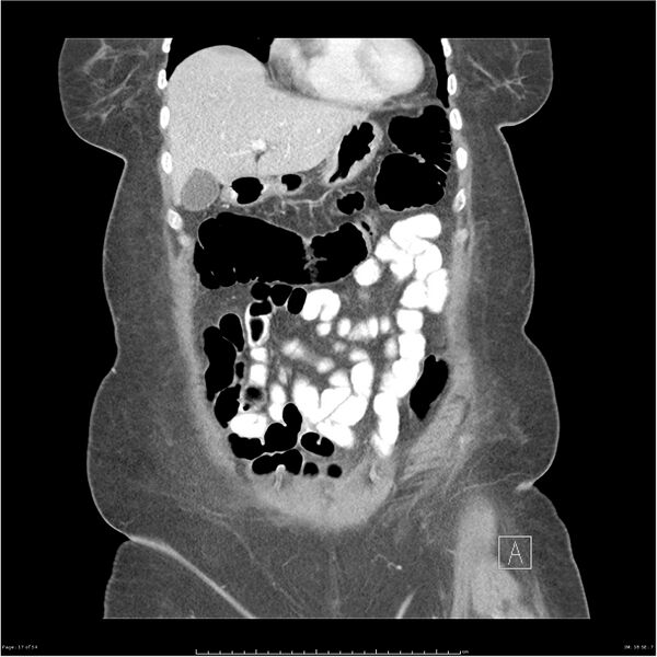 File:Bilateral psoas hematomas (Radiopaedia 24057-24279 B 17).jpg