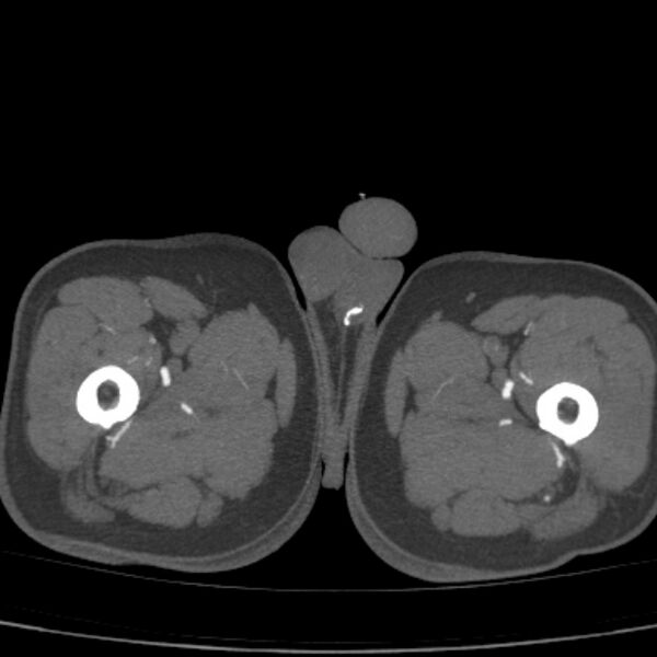 File:Bilateral superficial femoral arterial occlusion (Radiopaedia 25682-25857 A 35).jpg