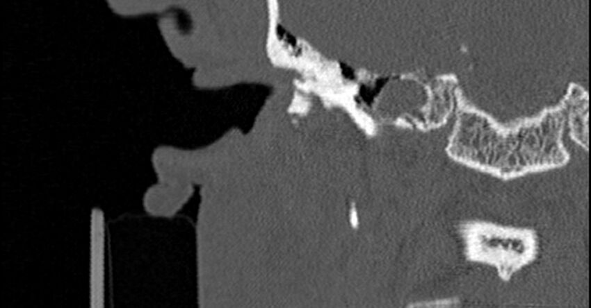 Bilateral temporal bone fractures (Radiopaedia 29482-29970 Coronal non-contrast 78).jpg