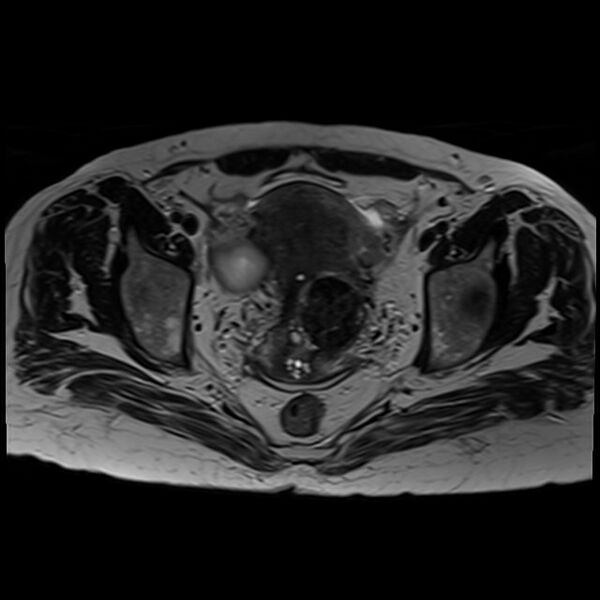 File:Bilateral tubo-ovarian abscesses (Radiopaedia 58635-65829 Axial T2 28).jpg