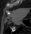 Bile leak from accessory duct(s) of Luschka post cholecystectomy (Radiopaedia 40736-43389 B 10).jpg