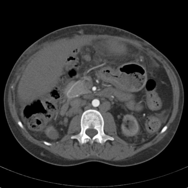 File:Biliary necrosis - liver transplant (Radiopaedia 21876-21846 A 32).jpg