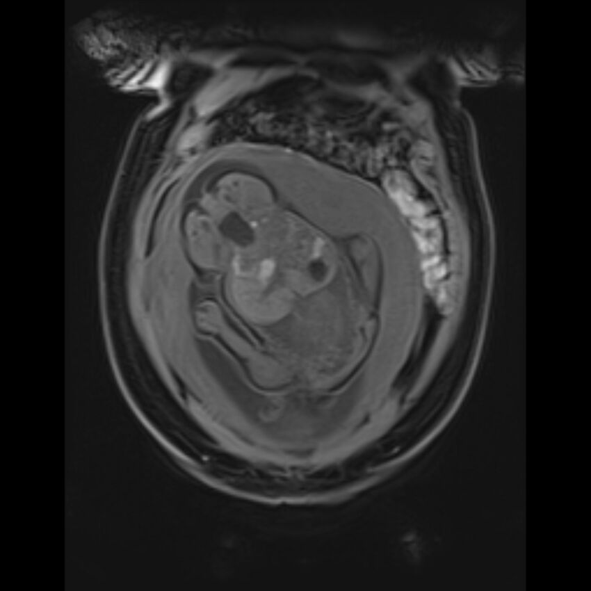 Bilobed placenta accreta (Radiopaedia 69648-79591 Coronal T1 vibe 41).jpg
