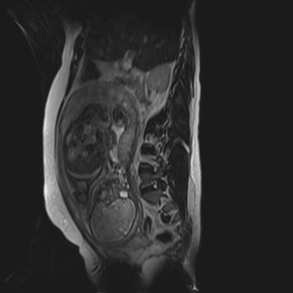 File:Bilobed placenta accreta (Radiopaedia 69648-79591 G 35).jpg