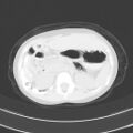 Bochdalek diaphragmatic hernia (Radiopaedia 38866-41059 Axial lung window 27).jpg