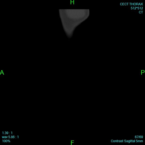File:Bone metastases from lung carcinoma (Radiopaedia 54703-60937 Sagittal bone window 67).jpg