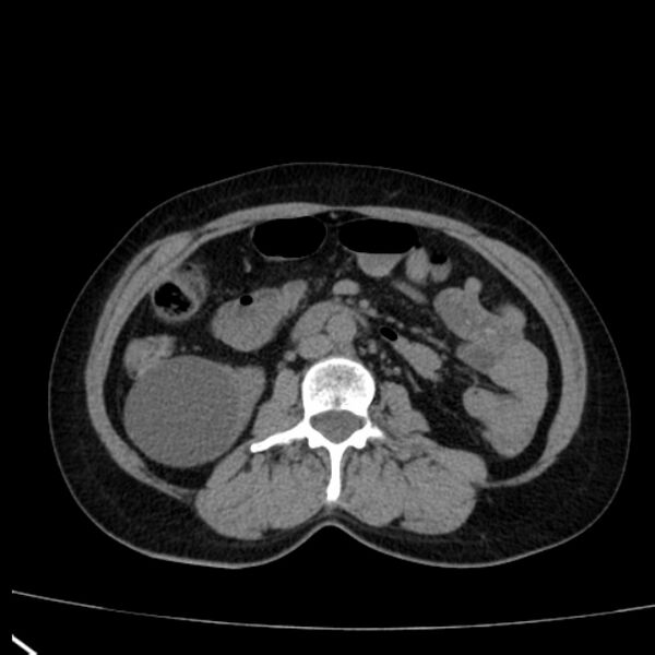 File:Bosniak renal cyst - type I (Radiopaedia 27479-27675 Axial non-contrast 46).jpg