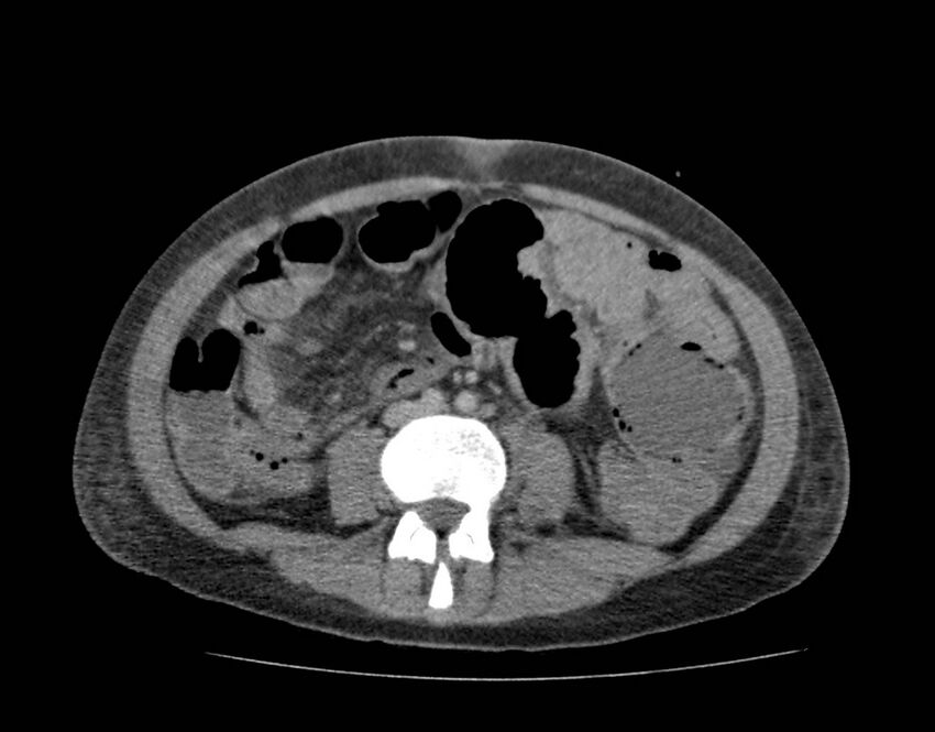 Bowel lymphoma complicated by bleeding after therapy (Radiopaedia 55601-62110 C 50).jpg