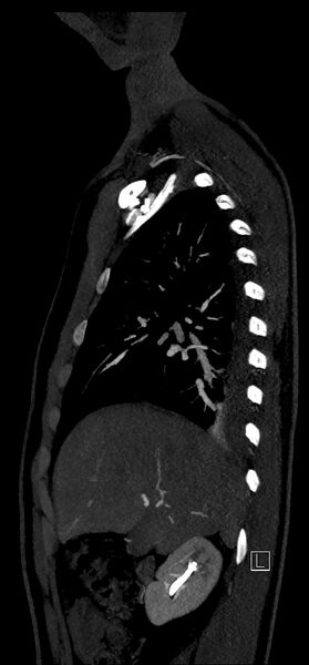 File:Brachiocephalic trunk pseudoaneurysm (Radiopaedia 70978-81191 C 29).jpg