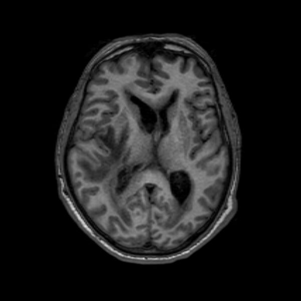 File:Brain abscess complicated by intraventricular rupture and ventriculitis (Radiopaedia 82434-96577 Axial T1 36).jpg