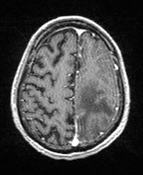 File:Brain abscess with dual rim sign (Radiopaedia 87566-103938 Axial T1 C+ 126).jpg