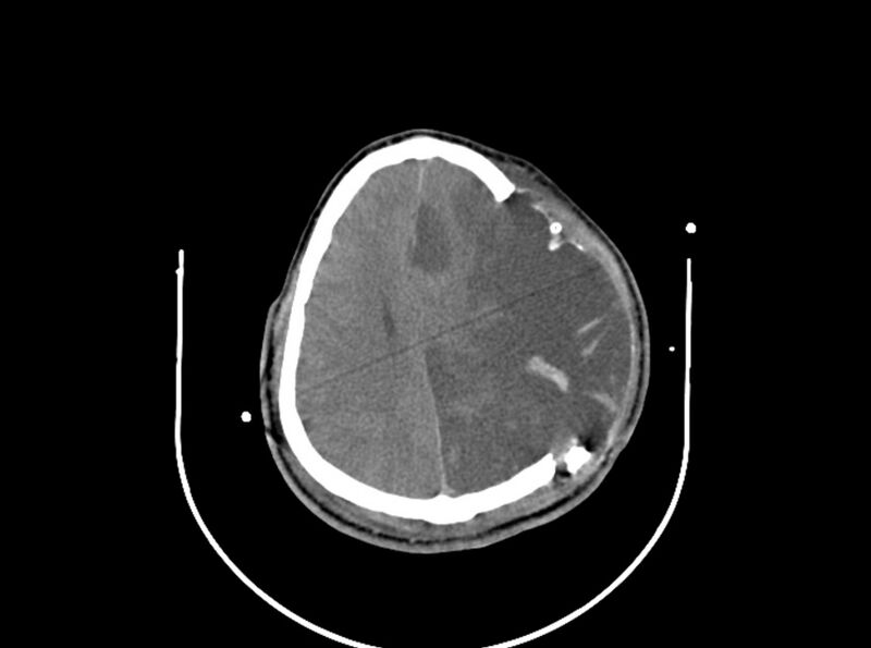 File:Brain injury by firearm projectile (Radiopaedia 82068-96087 B 133).jpg