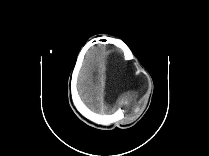 Brain injury by firearm projectile (Radiopaedia 82068-96088 A 164).jpg