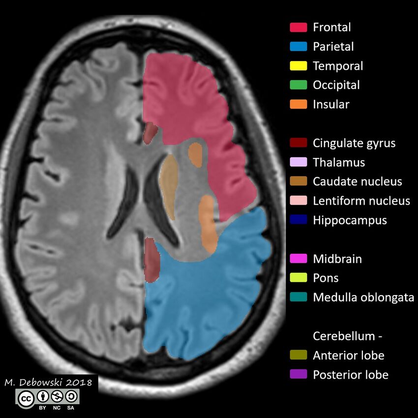 Brain lobes - annotated MRI (Radiopaedia 61691-69700 Axial 28).JPG