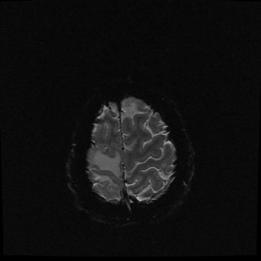 Brain metastases (renal cell carcinoma) (Radiopaedia 42571-45704 Axial SWI 2).jpg