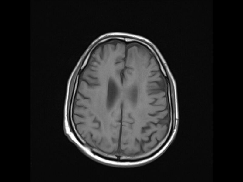 File:Brain metastases from renal cell carcinoma (Radiopaedia 42222-45297 Axial T1 18).jpg