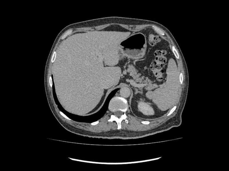 File:Brain metastases from renal cell carcinoma (Radiopaedia 42222-45328 Axial C+ delayed 4).jpg
