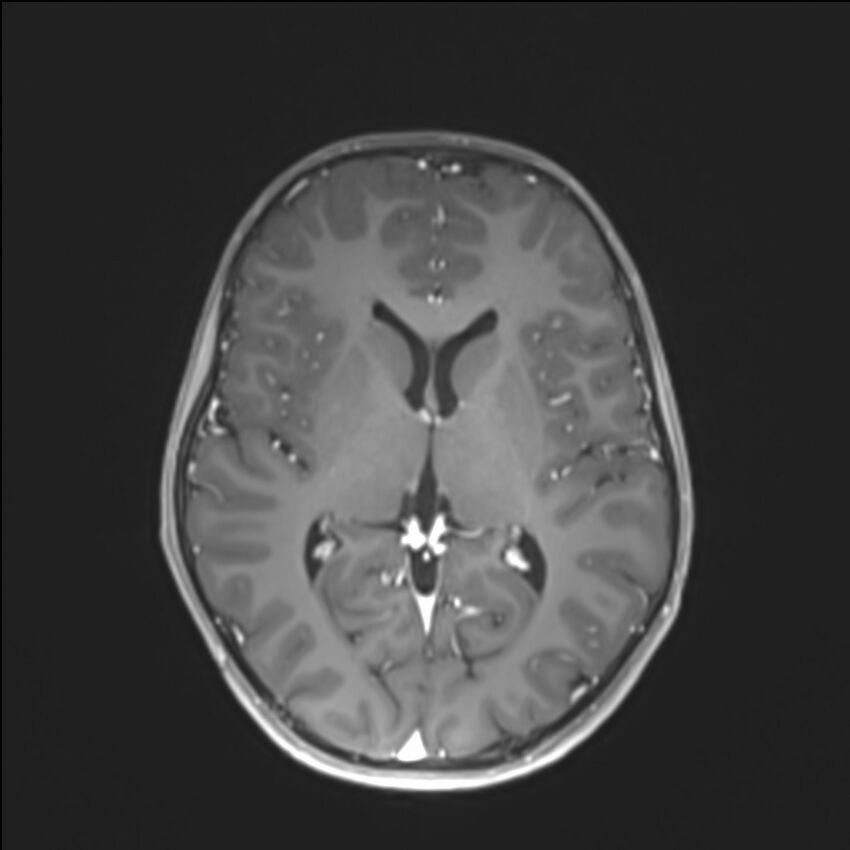Brainstem glioma (Radiopaedia 70548-80674 Axial T1 C+ 86).jpg