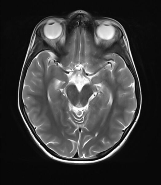 File:Brainstem glioma (Radiopaedia 70548-80674 Axial T2 11).jpg