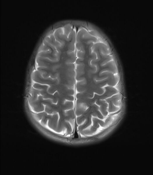 File:Brainstem glioma (Radiopaedia 70548-80674 Axial T2 20).jpg