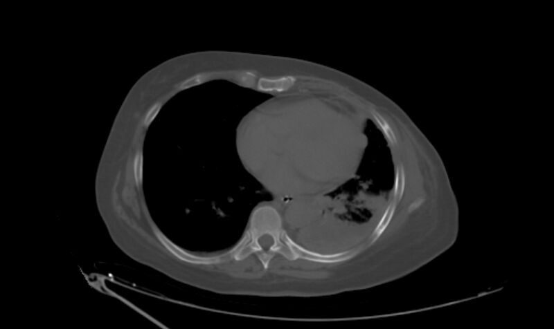 File:Breast cancer metastases (Radiopaedia 33184-34213 Axial bone window 4).jpg