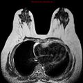 Breast carcinoma (multicentric multifocal in mammary Paget disease) (Radiopaedia 50966-56512 Axial T2 7).jpg