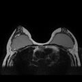 Breast implants - MRI (Radiopaedia 26864-27035 Axial T2 26).jpg