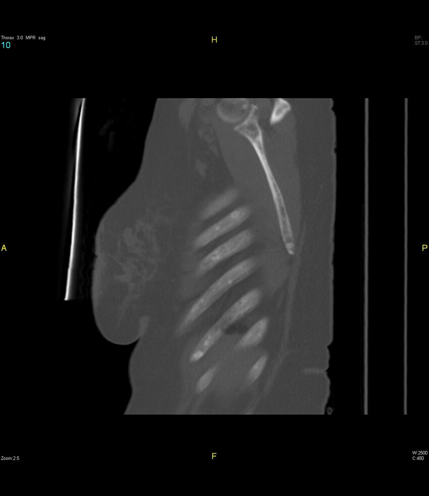 Breast primary with lung and bone metastases (Radiopaedia 40620-43228 Sagittal bone window 10).jpg