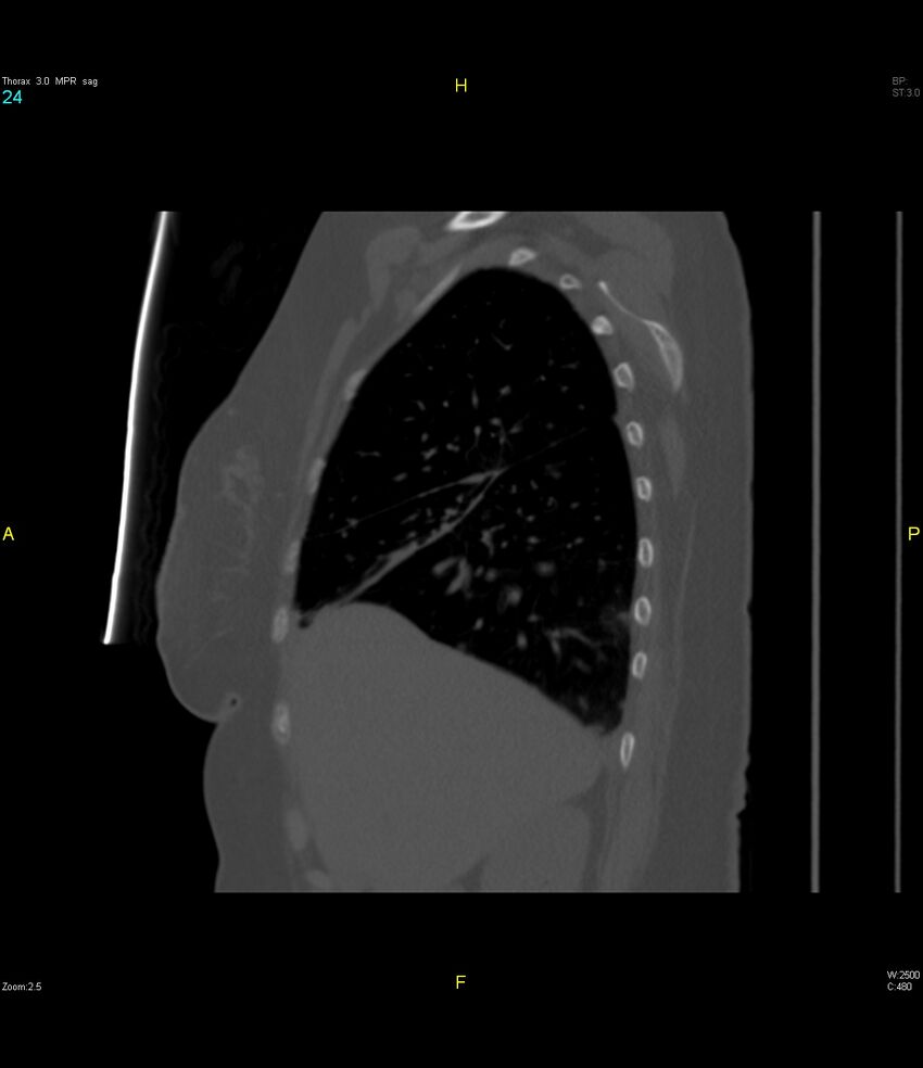 Breast primary with lung and bone metastases (Radiopaedia 40620-43228 Sagittal bone window 24).jpg