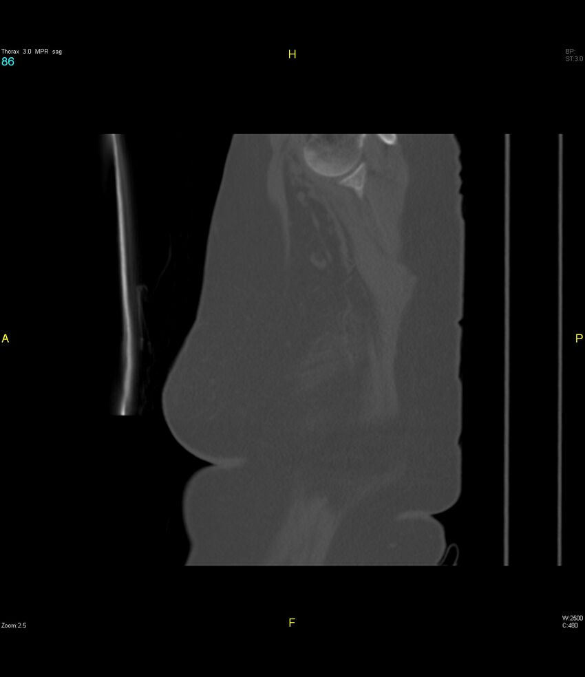 Breast primary with lung and bone metastases (Radiopaedia 40620-43228 Sagittal bone window 86).jpg