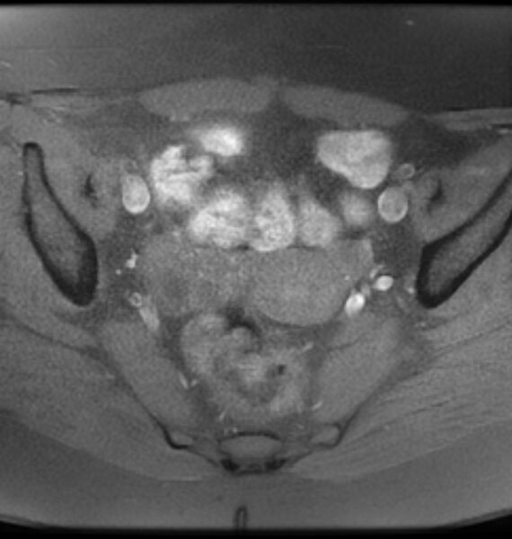 File:Broad ligament leiomyoma (Radiopaedia 81634-95516 Axial T1 fat sat 11).jpg