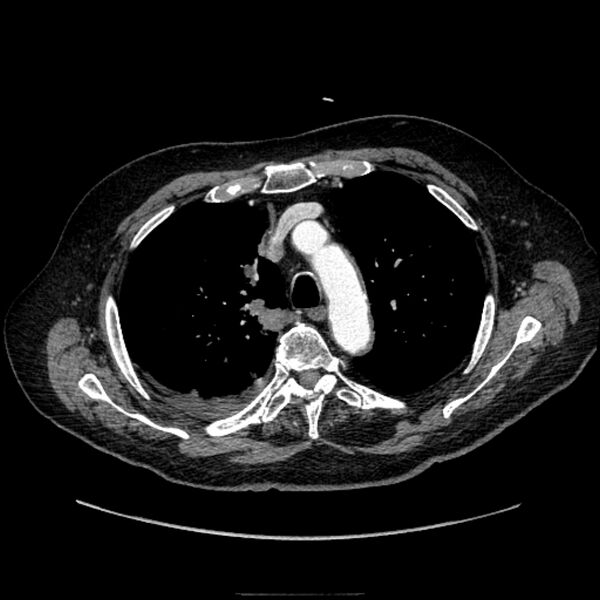File:Bronchogenic adenocarcinoma and pulmonary embolism (Radiopaedia 9097-9806 D 21).jpg