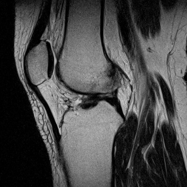File:Bucket handle tear - medial meniscus (Radiopaedia 79028-91942 Sagittal T2 11).jpg
