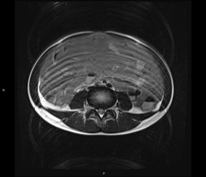 File:Burkitt lymphoma (bowel) (Radiopaedia 68839-78557 Axial T2 39).jpg