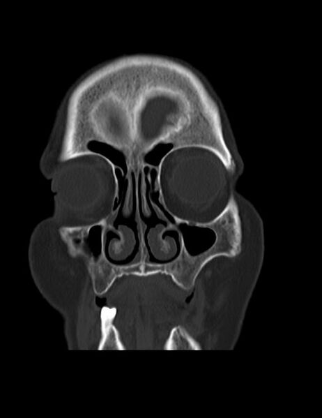 File:Burnt-out meningioma (Radiopaedia 51557-57337 Coronal bone window 5).jpg
